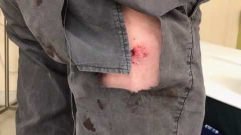 a man with torn pants showing punctured and bloody skin below