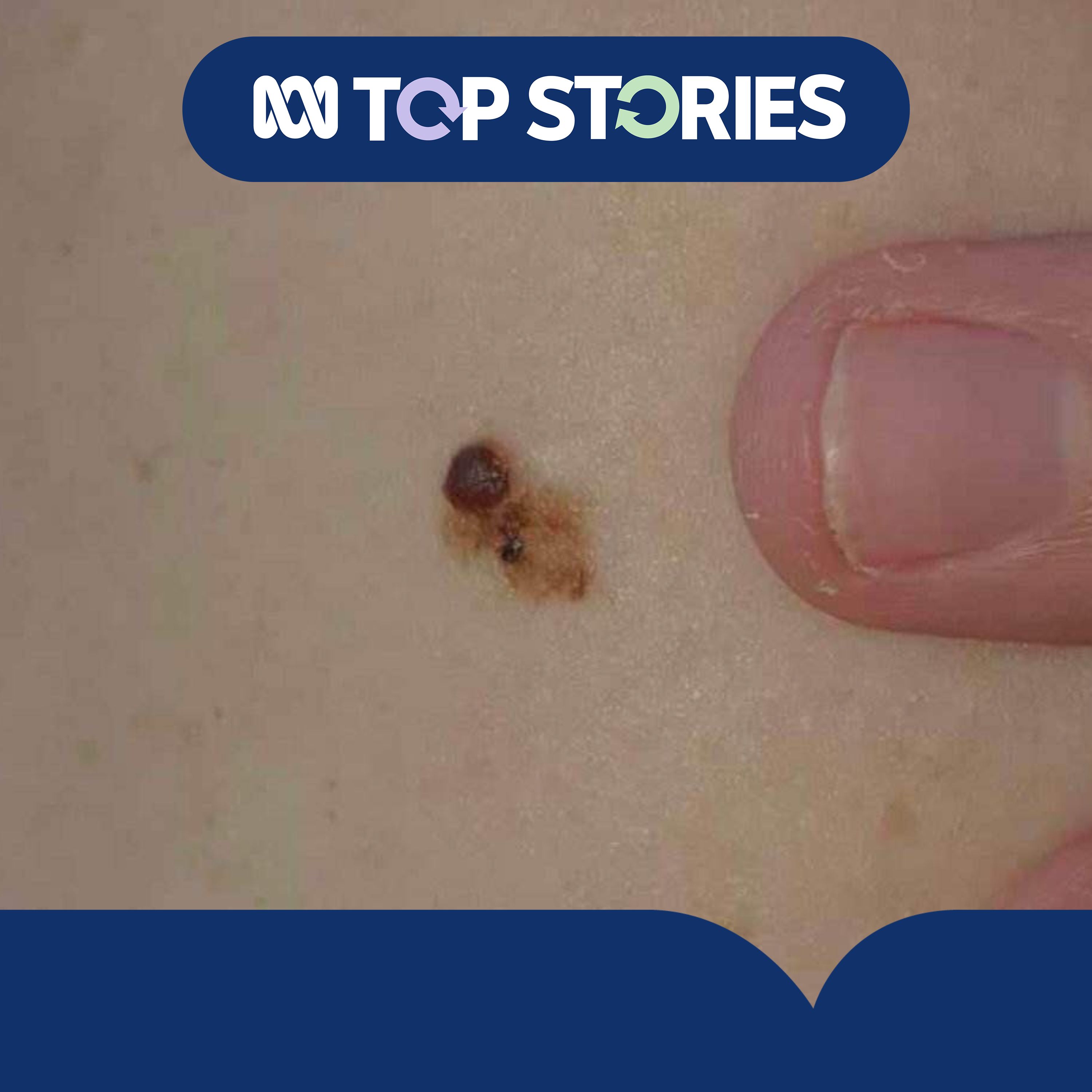 Could a vaccine stop melanoma deaths? episode artwork