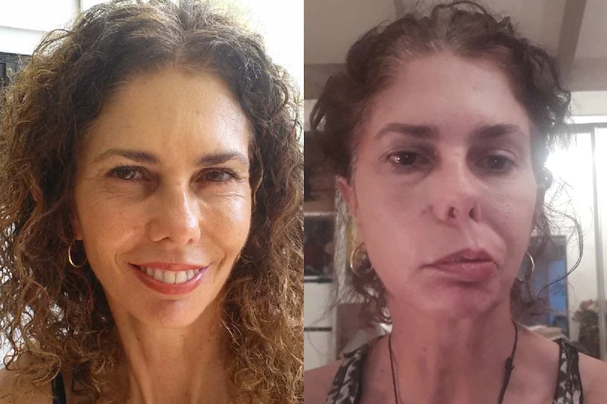 A before and after picture of Olivia Pozzan, the after showing her swelling cheek.