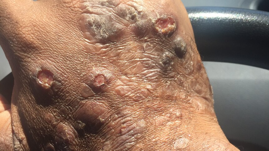 Dewayne Lee Johnson's hand, covered in legions caused by a rare form of cancer.