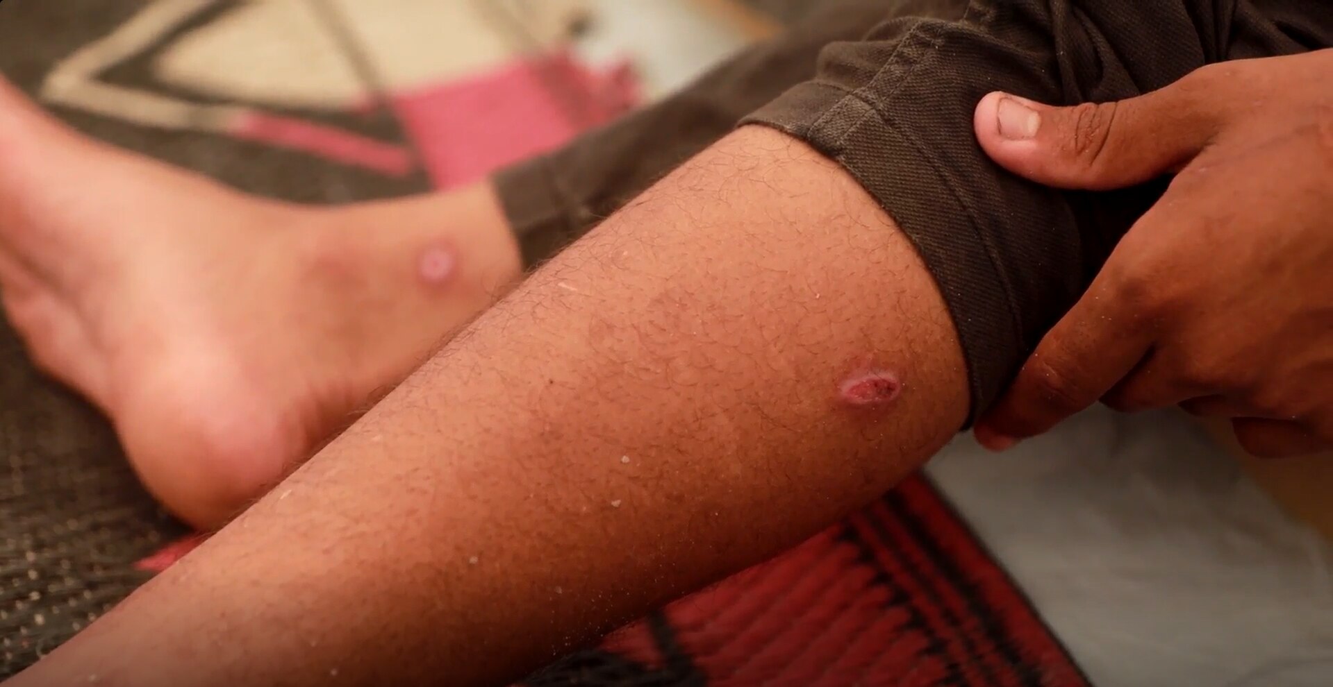 A boy's leg with a wound on it