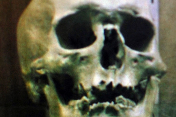 Skull riddle: This skull was taken from Old Melbourne Goal in 1978.