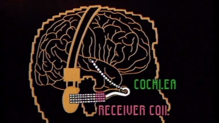 schematic of cochlear implant