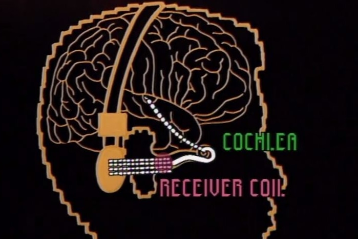 Schematic of cochlear implant