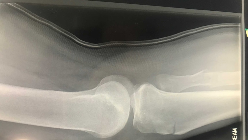 An x-ray of a broken left and dislocated knee.