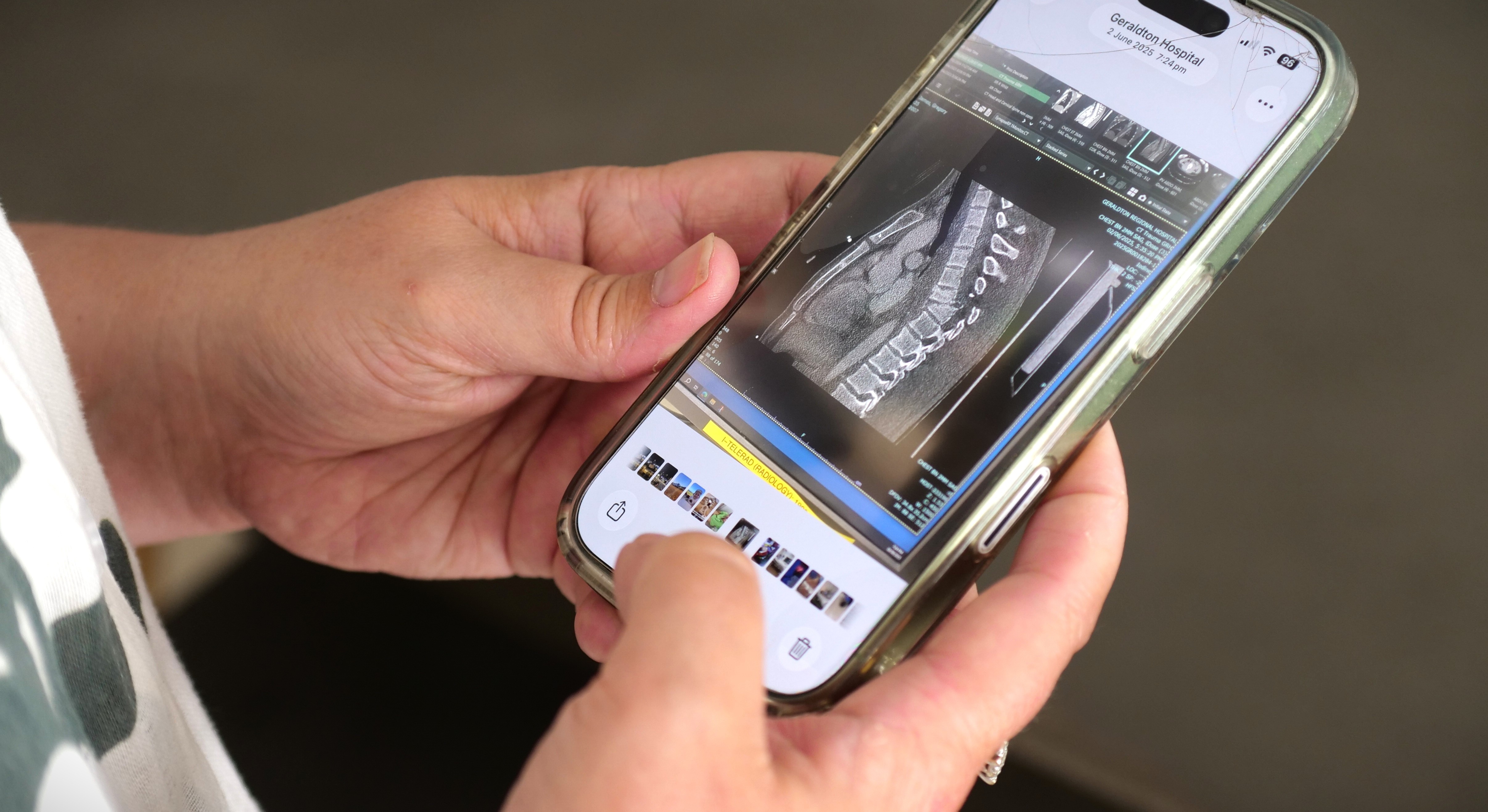 An x-ray image on a phone which is being held.