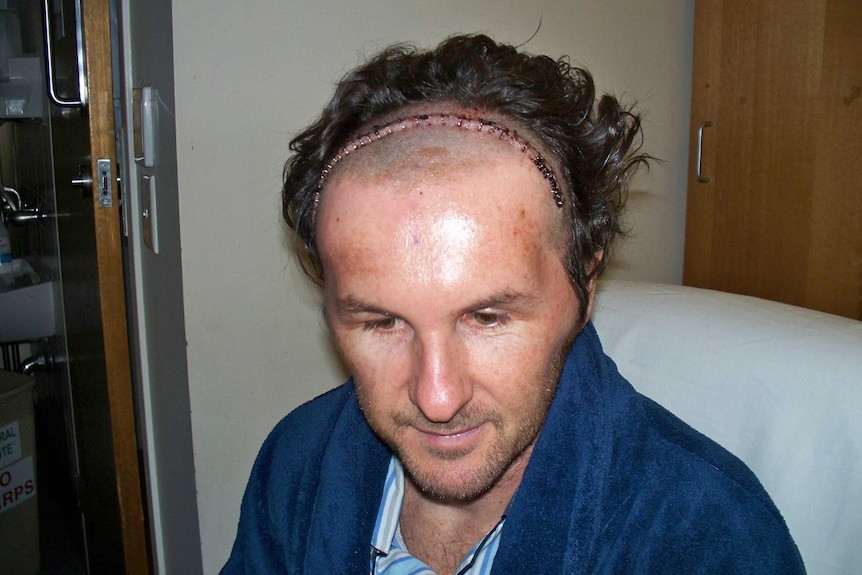 Tom Greenaway after surgery to remove a brain tumour in 2012.
