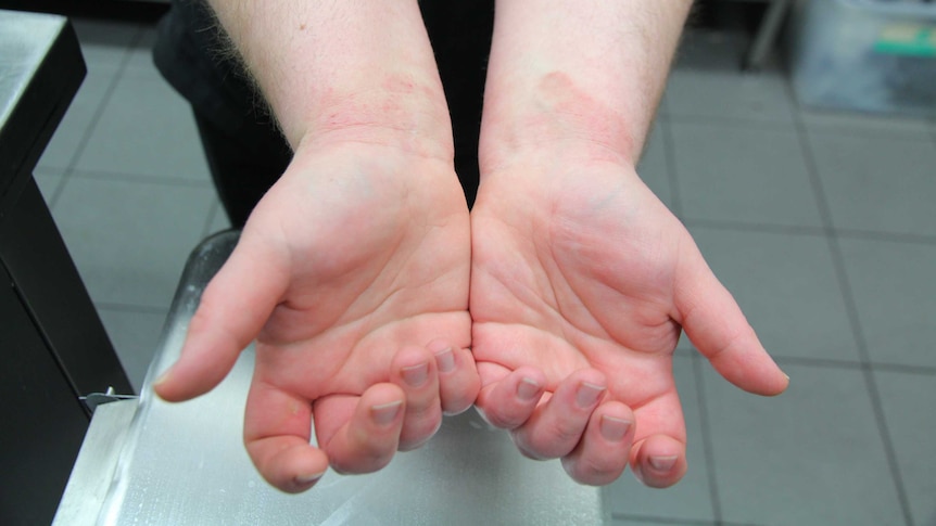 A close-up shot of a woman's hands and wrists. Red blotches of eczema can be seen on her wrists.