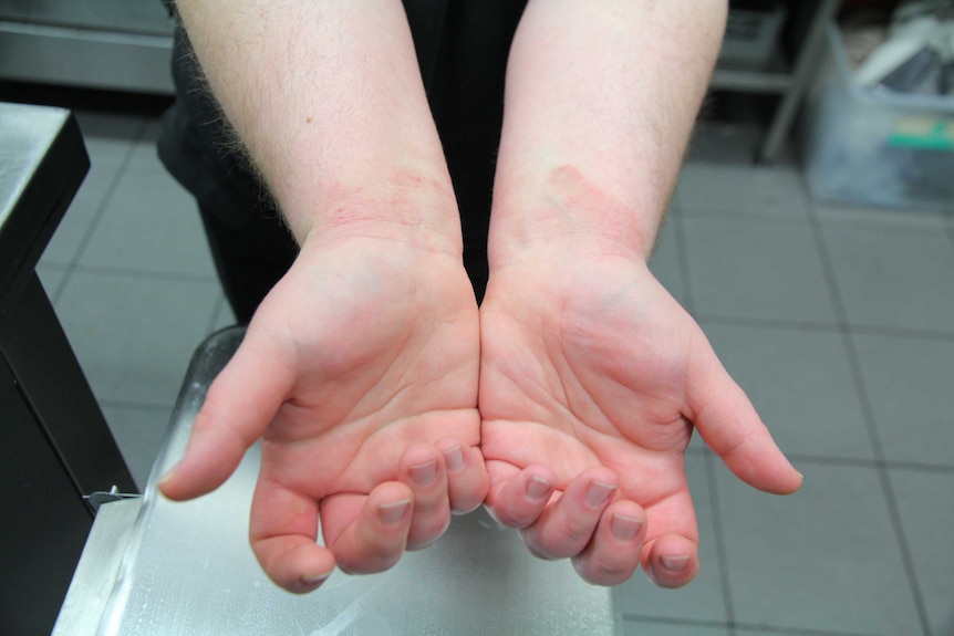 A close-up shot of a woman's hands and wrists. Red blotches of eczema can be seen on her wrists.