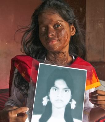 Hasina holds a photo of her younger self, before the acid attack