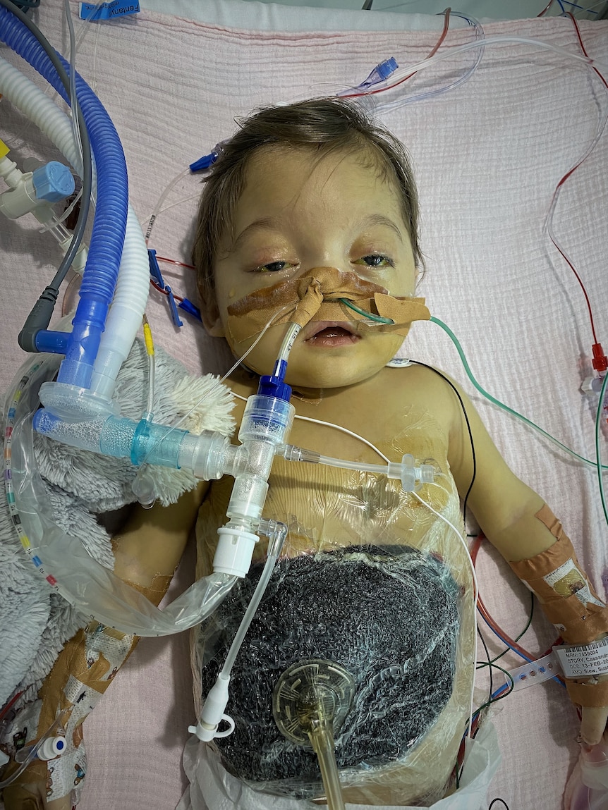 A baby looking poorly after an organ transplant.