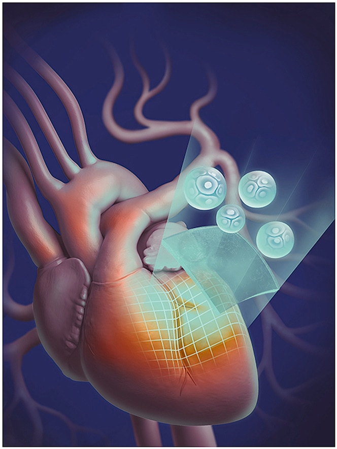 An animation of a human heart with a blue patch being placed onto a section of it.