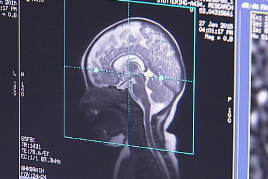 Researchers hope to use brain scans to discover what causes stuttering.