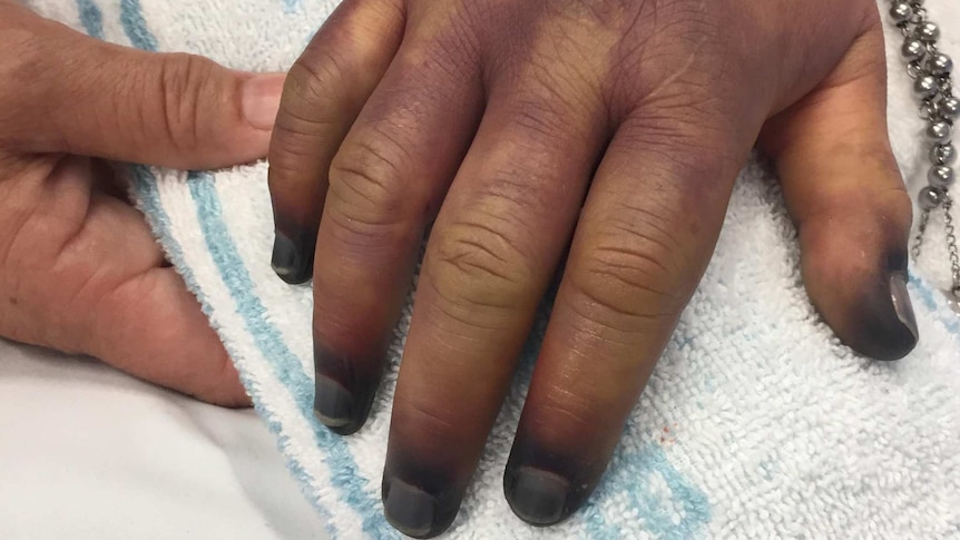 A close-up of a hand with purple blotches on it.