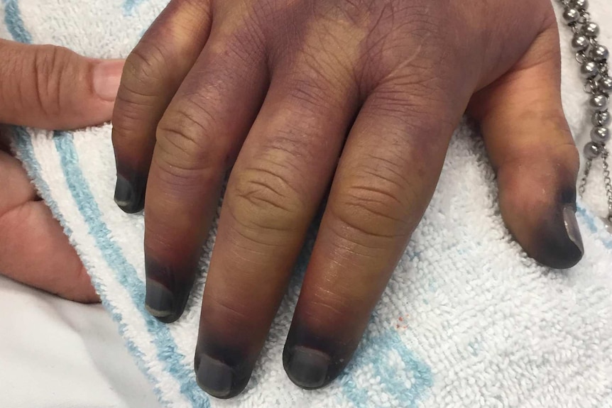 A close-up of a hand with purple blotches on it.