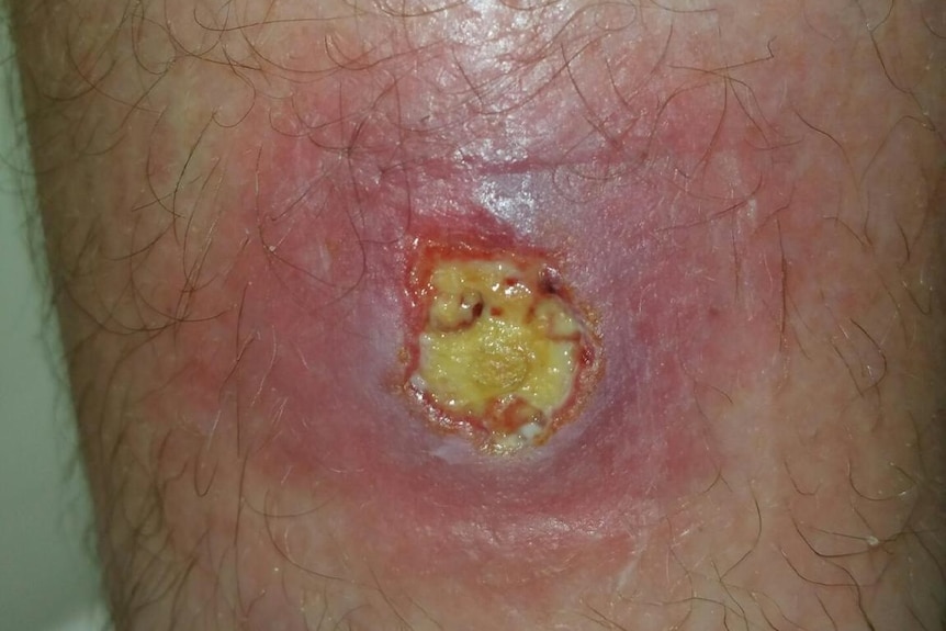 Mornington Peninsula builder Anthony Fleming suffered a flesh-eating bacteria on his leg, known as Mycobacterium Ulcerans.