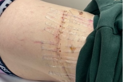 Stitches left following surgery.