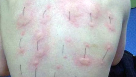 Allergy sufferer Ryan Pearn shows welts on his back.