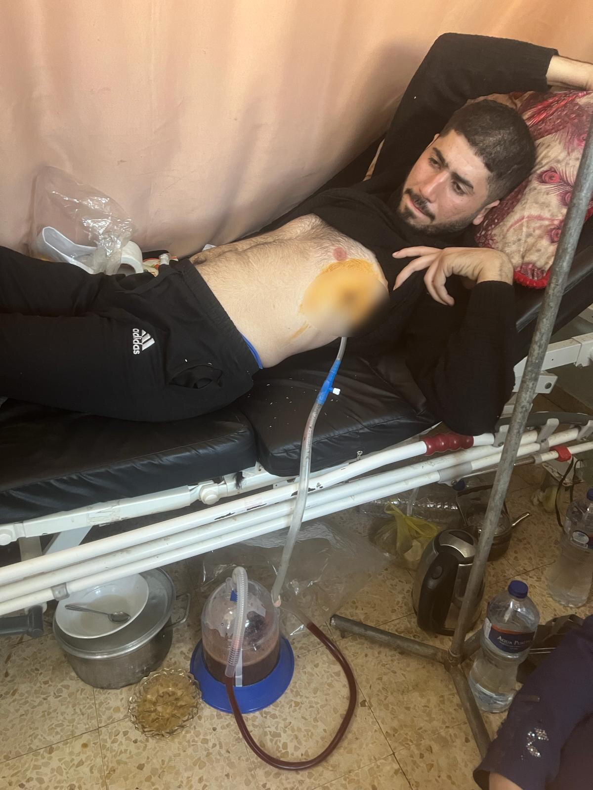 A man with a tube coming out of his chest 