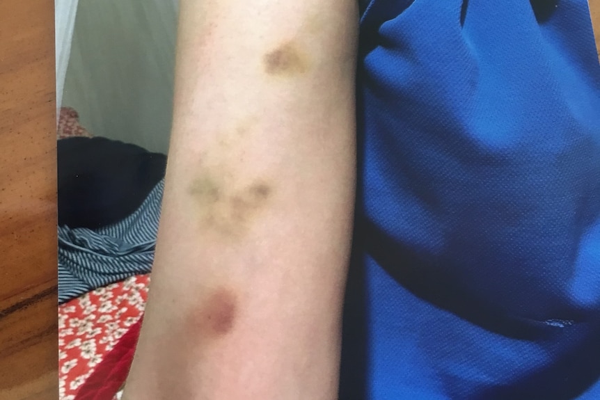 Jane Barnett with bruises up her arms