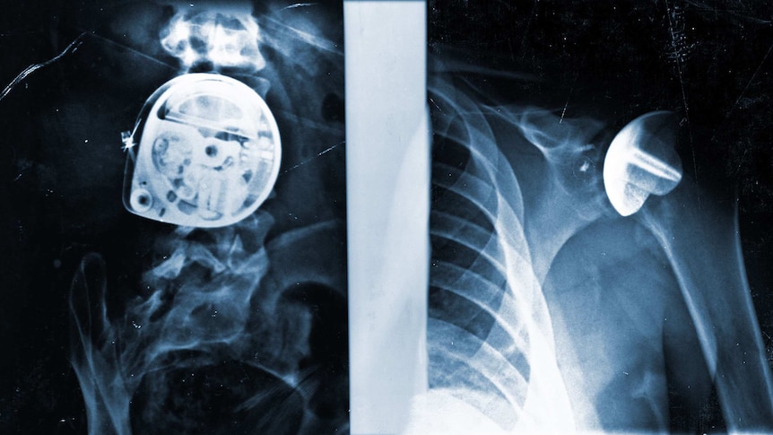 X-rays of faulty medical devices implanted inside bodies.