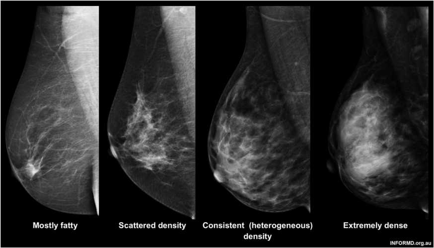 A mammogram shows the difference in breast density, from type A (low density) to type D (extremely dense).