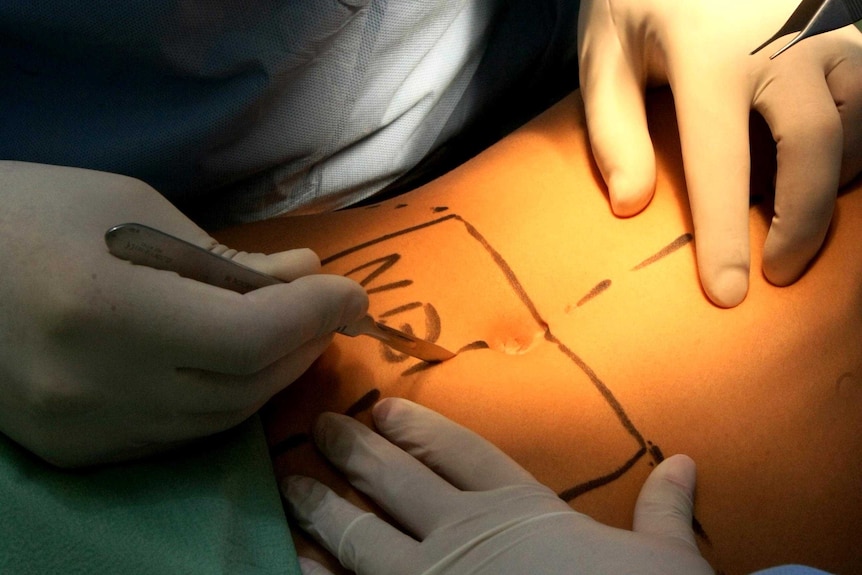 A doctor prepares to make an incision on a patient's stomach in a cosmetic surgery procedure.