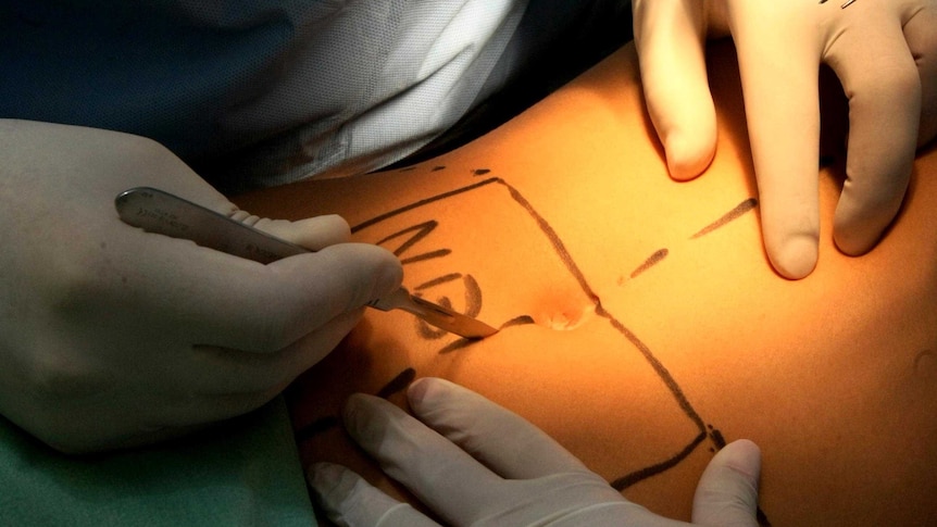 A doctor prepares to make an incision on a patients stomach in a plastic surgery procedure.