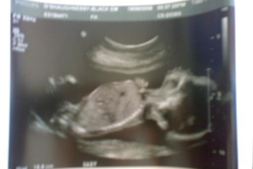 ultrasound picture of baby boy taken in Perth