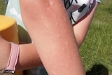 A girl's arm with bites. 