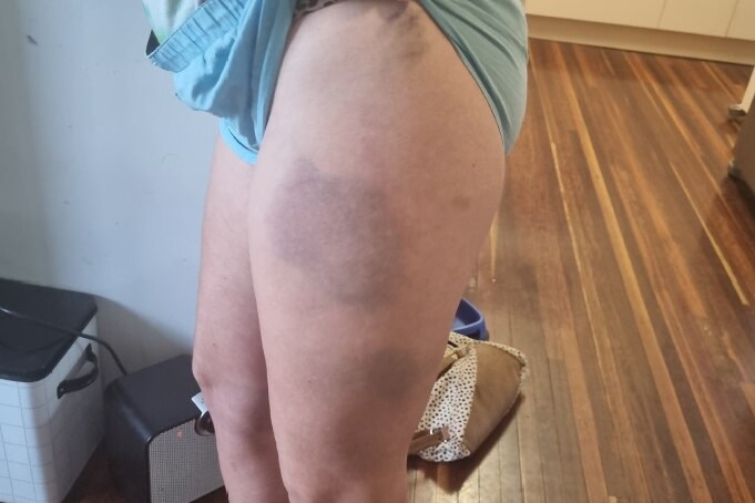 A woman holding up her shorts to show a large bruise on her leg