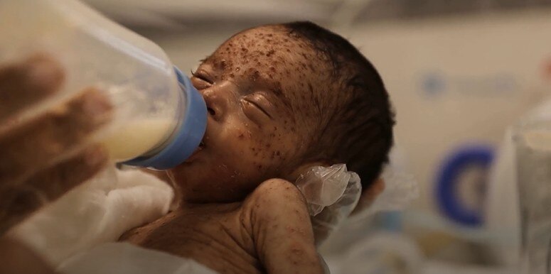 Chickenpox outbreak spreads in Gaza