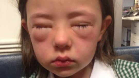 Amelie King suffers an allergic reaction