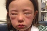 Amelie King suffers an allergic reaction