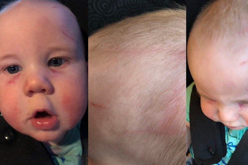 A seven-month-old boy with scratches on his face and head. 