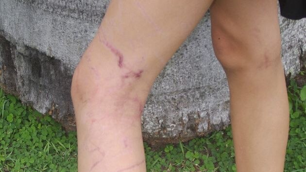 Box jellyfish scars on outside of Rachael Shardlow's legs in April, 2010.