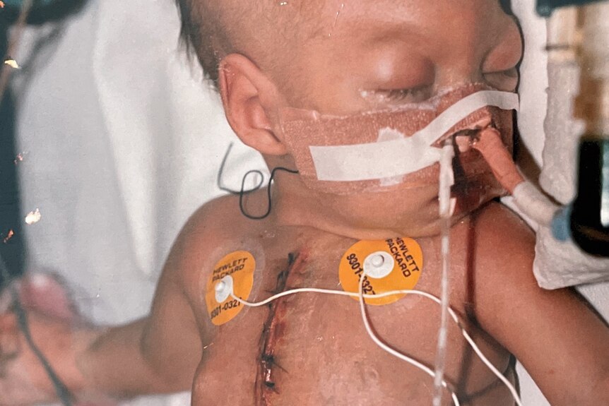A baby with a heart rate monitor and breathing support lying a crib, with stitches down her chest.