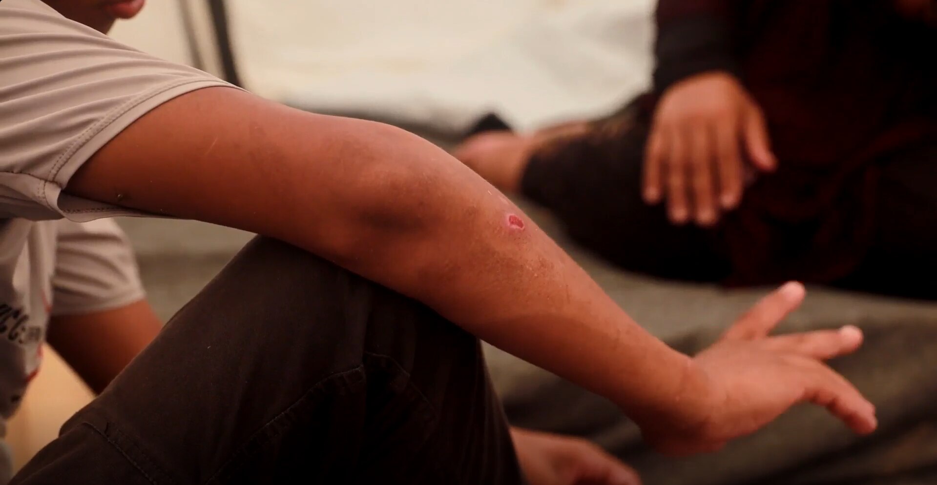 A close-up of a wound on a boy's elbow