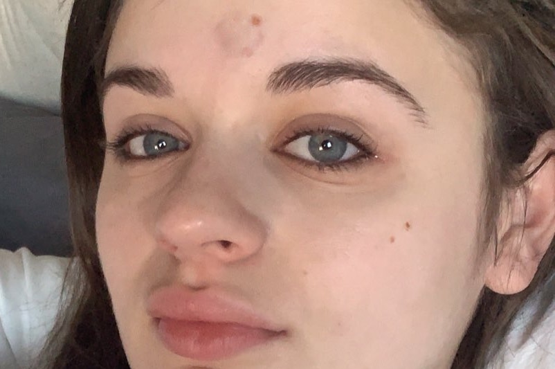 A close up of Joey King in bed with a circular welt on her forehead.