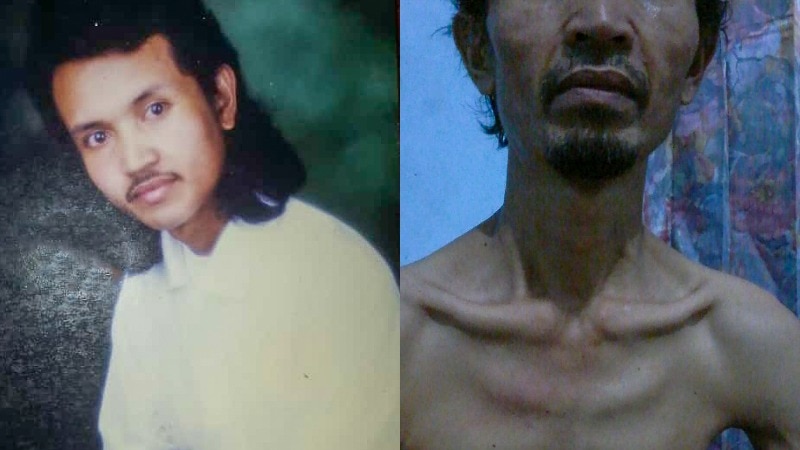 A composite of Sriyono looking young and healthy, and looking skeletal after his cancer diagnosis