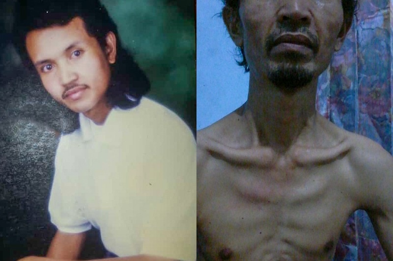 A composite of Sriyono looking young and healthy, and looking skeletal after his cancer diagnosis