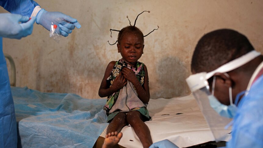 a young girl sits on a bed as a doctor in protective equipment collects skin samples
