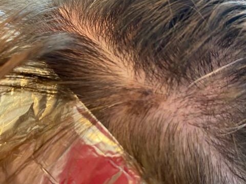 A discoloured freckle on a scalp. 