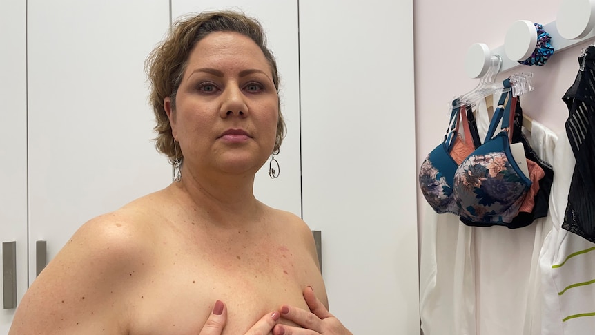 A topless woman with short brown hair stands in a changeroom with bras on the wall. Her hands cover scars on her chest.