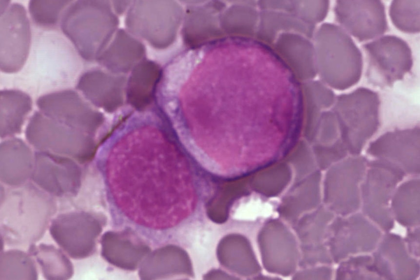 Leukemia cells under a microscope