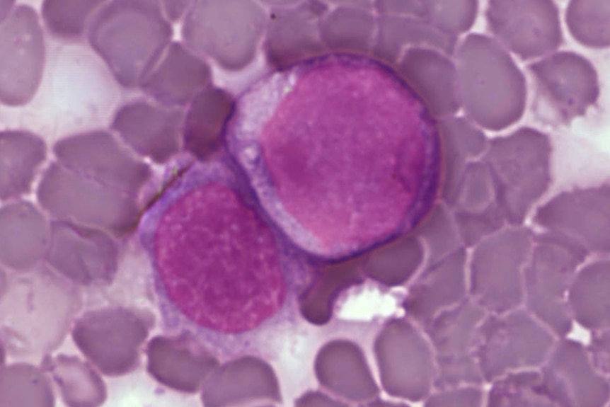 Leukemia cells under a microscope