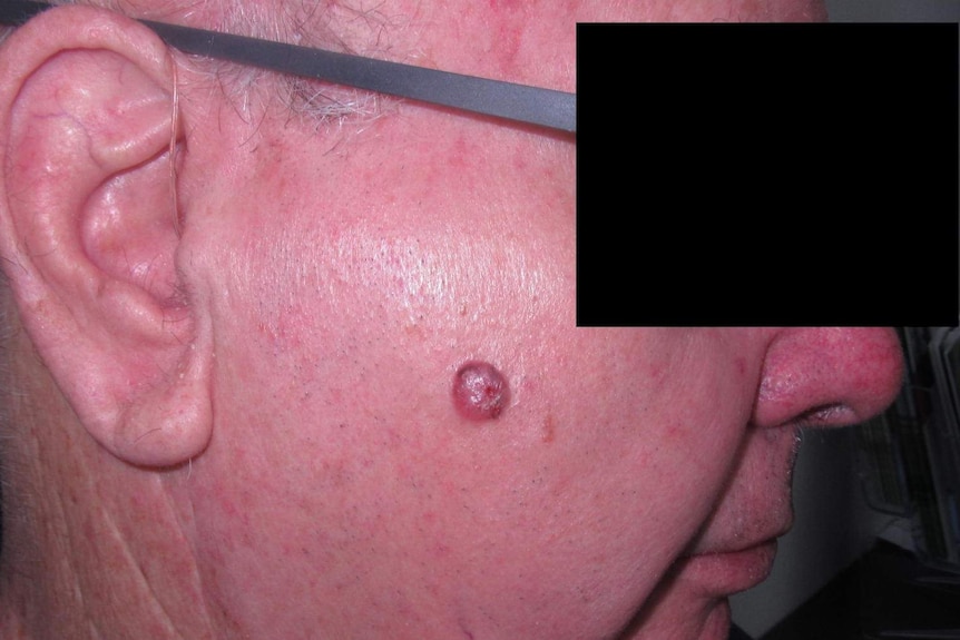 Close up clinical photo of a large BCC on a man's right cheek.