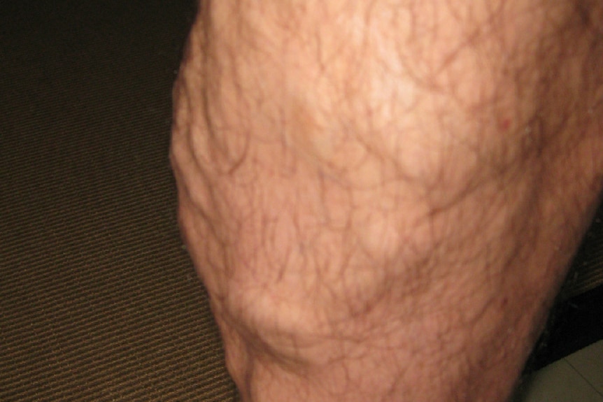 Varicose veins on person's leg.