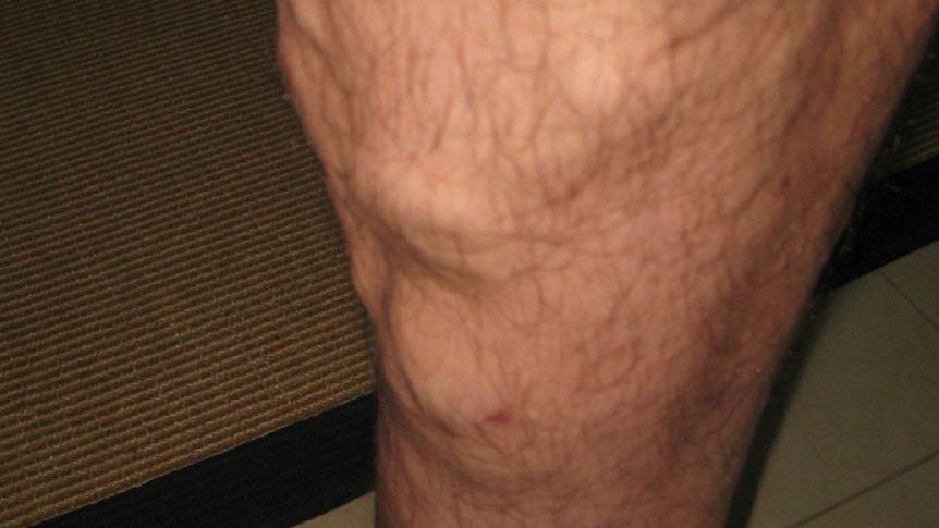 Varicose veins on person's leg.