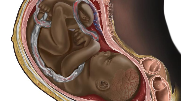 A medical illustration depicting a Black foetus in a pregnant woman 